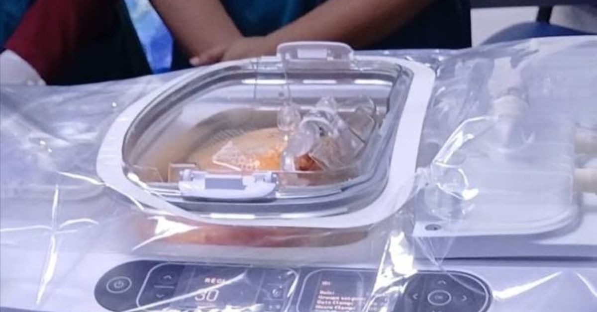 لأول مرة: فريق طبي بمستشفى شارل نيكول يستخدم تقنية "لايف بورت" لزراعة الكلى