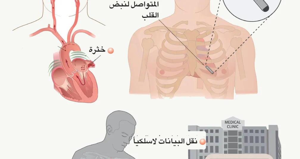 استشارات طبية: مسجّل مزروع لرصد نبضات القلب وحلول لإزعاج غازات البطن استشارات: مُسجِّل مزروع لرصد نبضات القلب - إزعاج غازات البطن