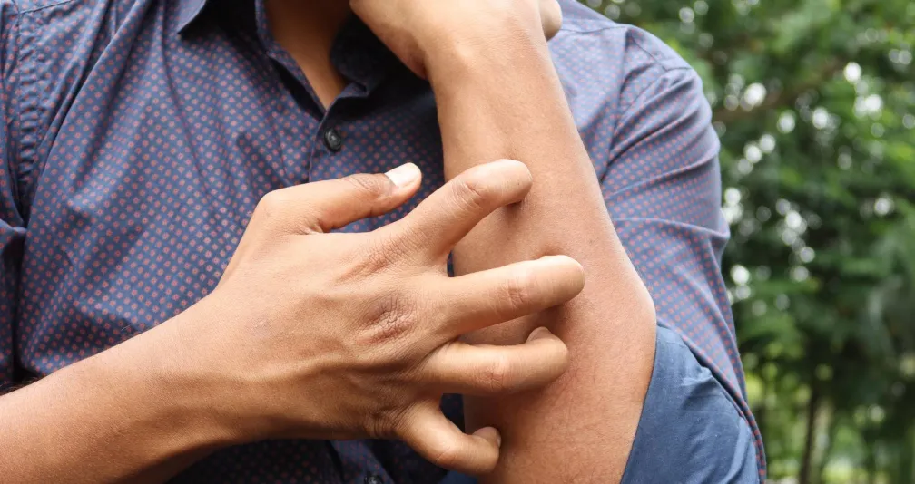 التهابات الجلد في الصيف... أسبابها وطرق الوقاية منها