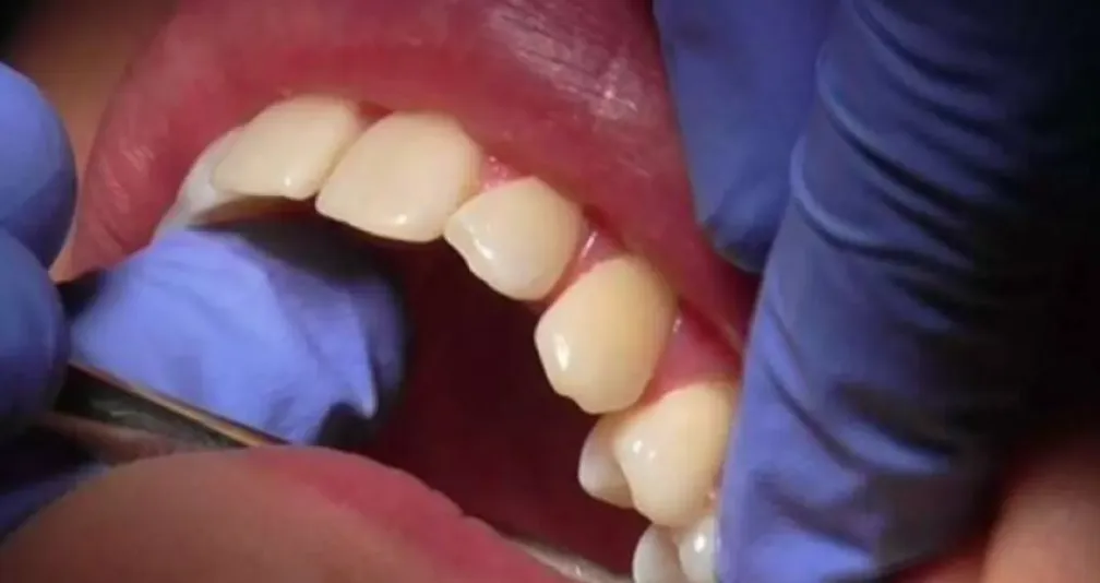 ما علاقة تنظيف الأسنان يومياً بصحة القلب والشرايين؟
