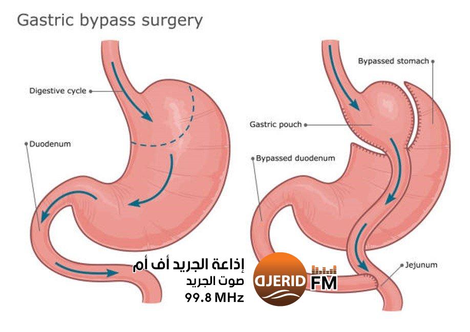 عملية تحويل المسار - مجلة انا حواء عملية تحويل المسار - مجلة انا حواء